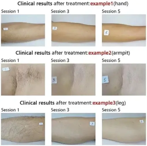 Single Handle Three Wavelength Diode Laser