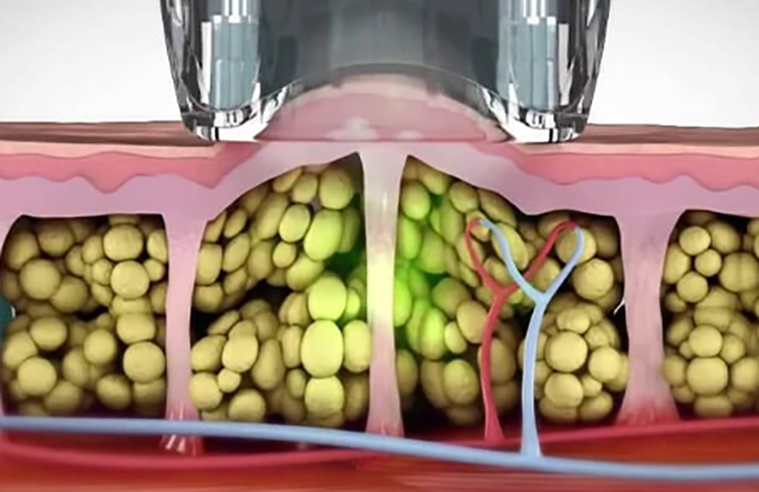 5 in 1 Body Shape machine